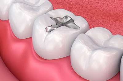 Identical Dental | Ceramic Crowns, Dental Cleanings and Dentures