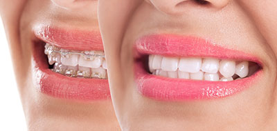 Identical Dental | Dental Sealants, Pediatric Dentistry and Night Guards