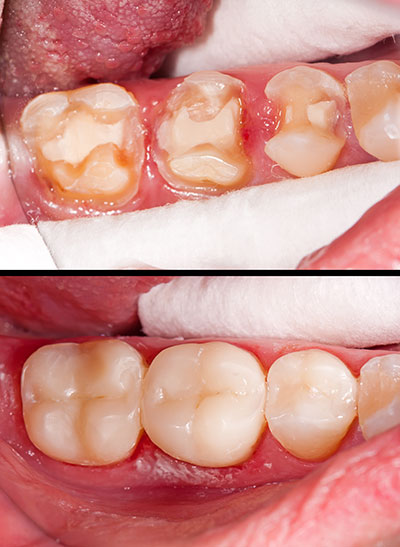Identical Dental | Ceramic Crowns, Fluoride Treatment and Oral Exams