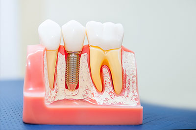 Identical Dental | Dental Fillings, Extractions and Dentures