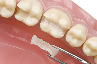 Identical Dental | Dental Fillings, Implant Dentistry and Preventative Program