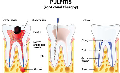 Identical Dental | Night Guards, Inlays  amp  Onlays and Veneers