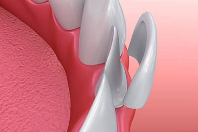 Identical Dental | Dental Bridges, Teeth Whitening and TMJ Disorders