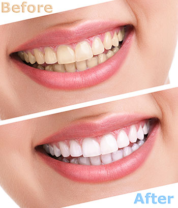Identical Dental | Dental Cleanings, Dental Sealants and Oral Exams